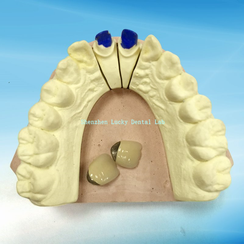 Dental Semi Precious Pd-Ag Crown